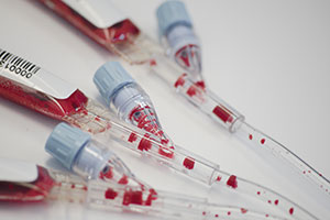 N�mero crescente de aplica��es cl�nicas das c�lulas estaminais do sangue do cord�o umbilical 