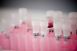 Células estaminais do sangue do cordão umbilical no tratamento da esclerose múltipla